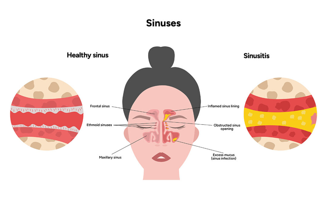 Maxillary vs. Frontal Sinusitis: Symptoms, Causes and Treatments